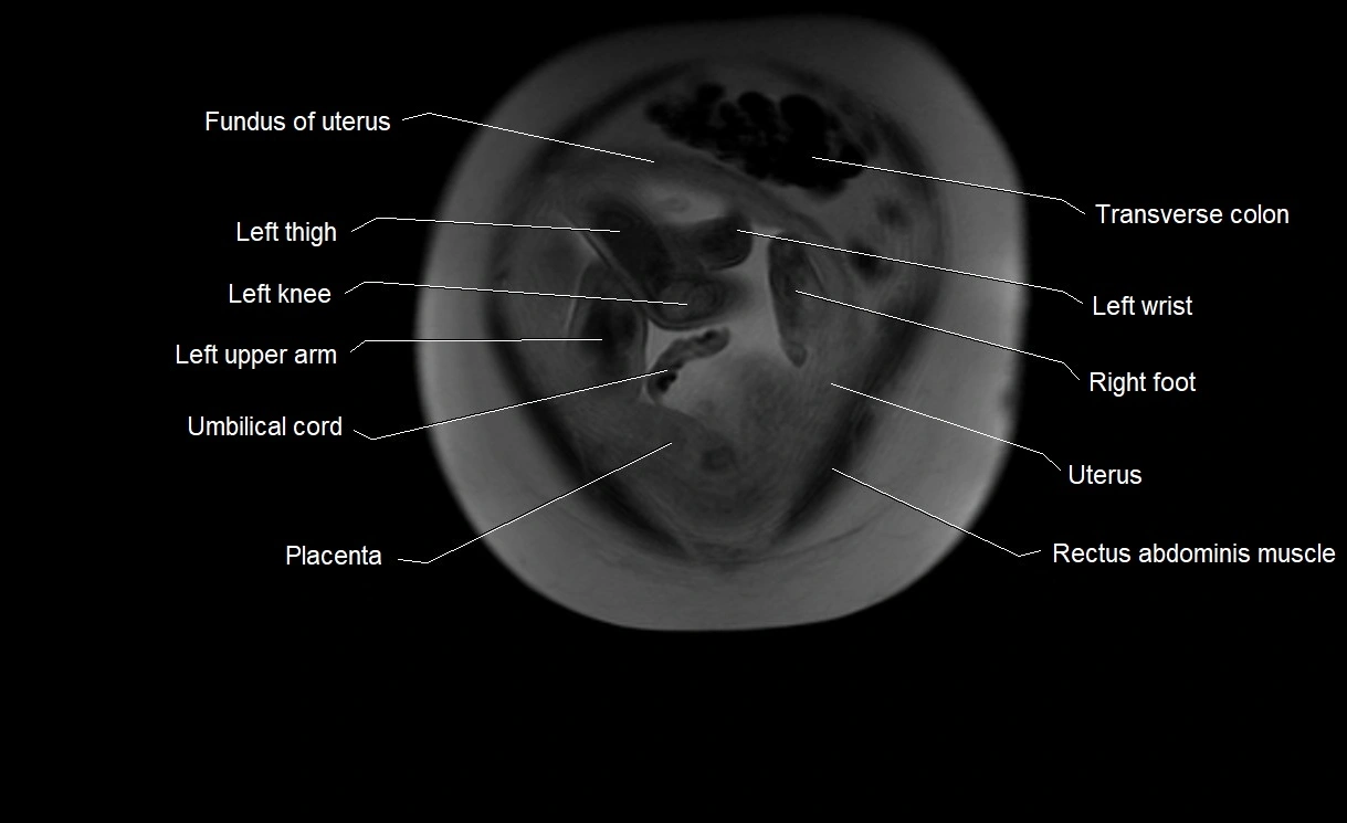 MRI Anatomy of pregnancy image 5.webp